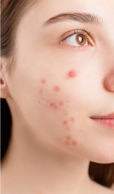 Enhance Your Product Value with Salicylic Acid เพิ่มมูลค่าให้ผลิตภัณฑ์ของคุณด้วยกรดซาลิไซลิก